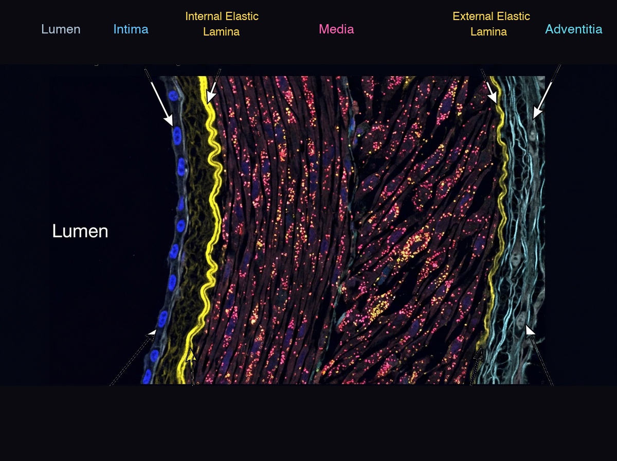 Xenium spatial transcriptomics of tibial artery