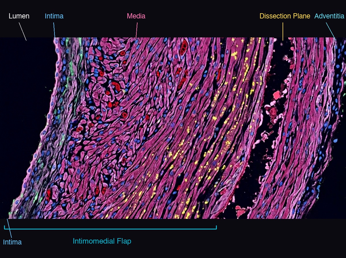 Transmural aortic wall cross-section showing lumen on left, intima, media, intimomedial flap, dissection plane in outer media, and adventitia on right